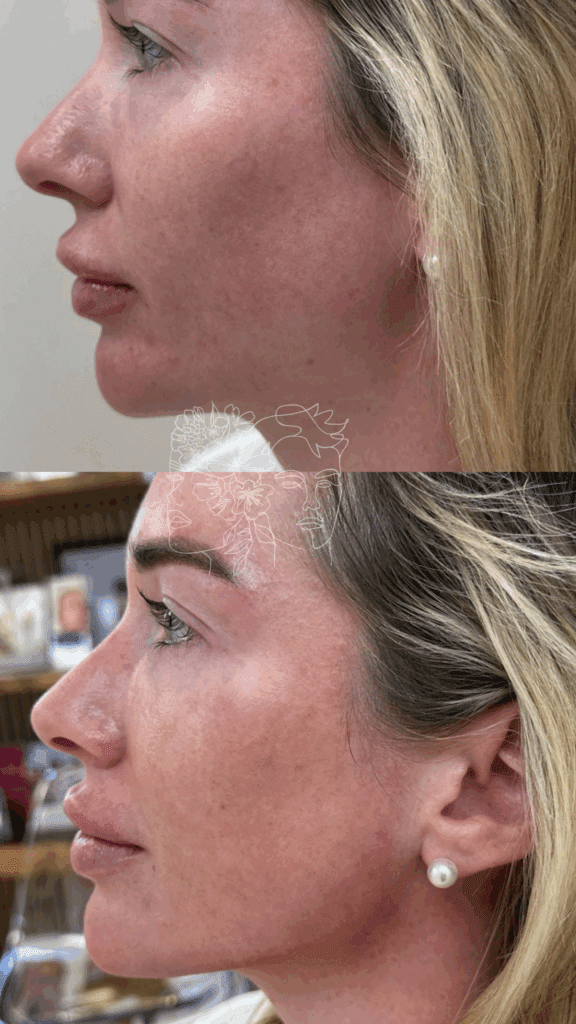 Gallery 19 1 syringe of hyaluronic acid filler for natural jawline definition