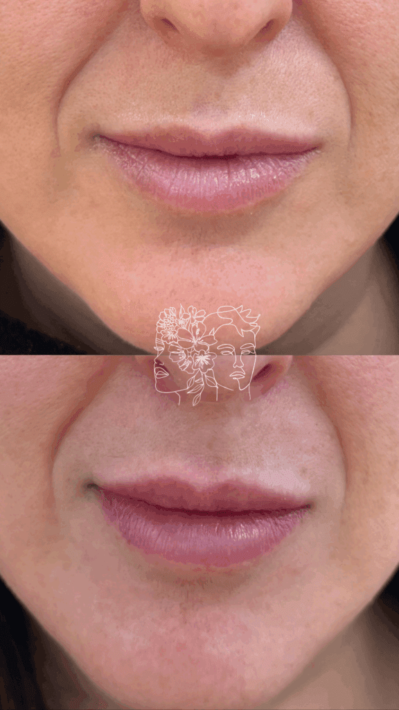 Gallery 20 1/2 syringe of hyaluronic acid filler for natural lip enhancement