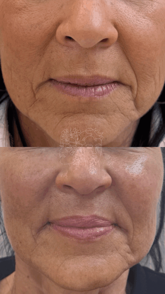 Gallery 29 2 sessions of Sculptra® for softening fine lines and collagen restoration