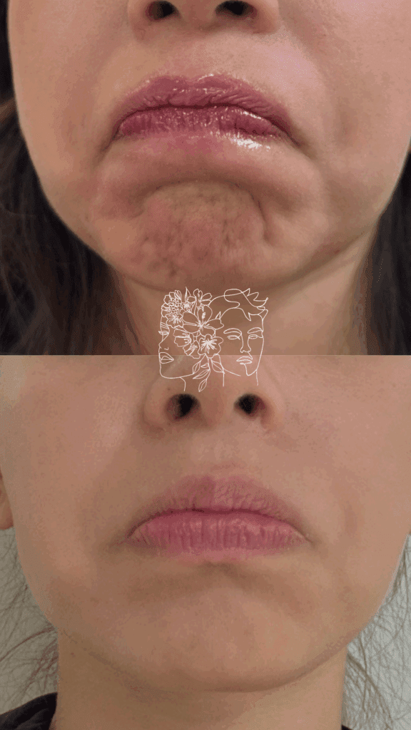 Gallery 8 Neuromodulator treatment of mentalis (Chin) and DAO's (frowning muscle)