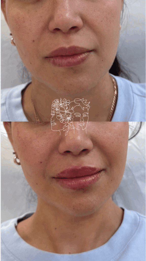 Gallery 21 1/2 syringe of hyaluronic acid filler for natural lip enhancement