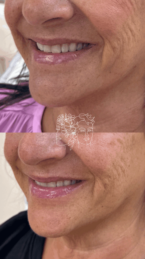 Gallery 31 1 sessions of Sculptra® for softening fine lines and collagen restoration