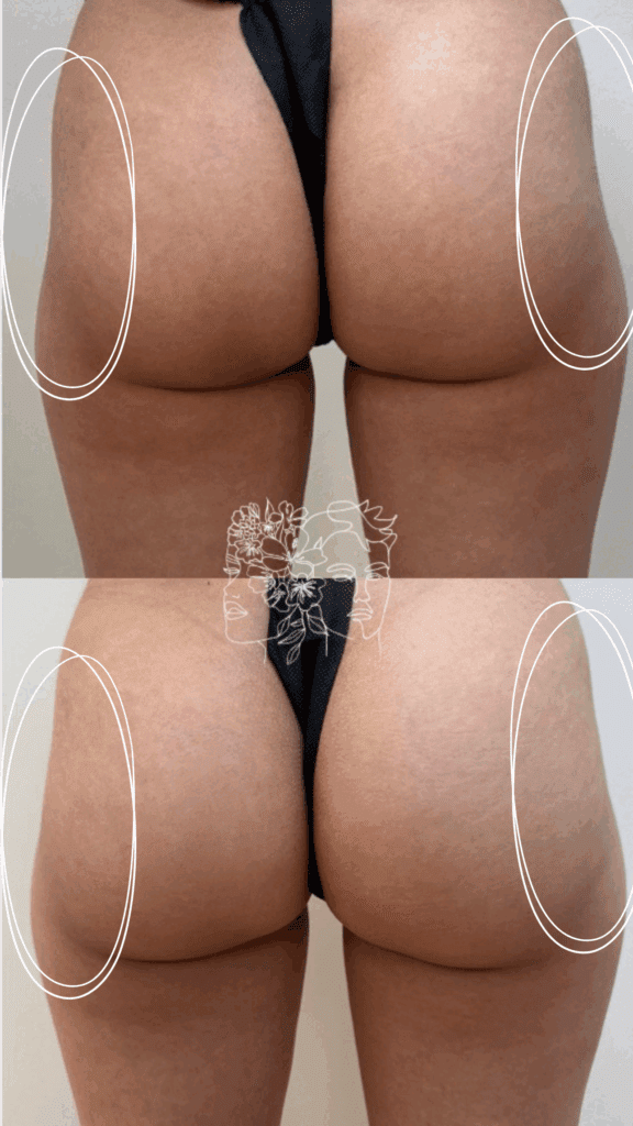 Gallery 30 1 session of Radiesse® for adding structure and natural correction of "hip dips"