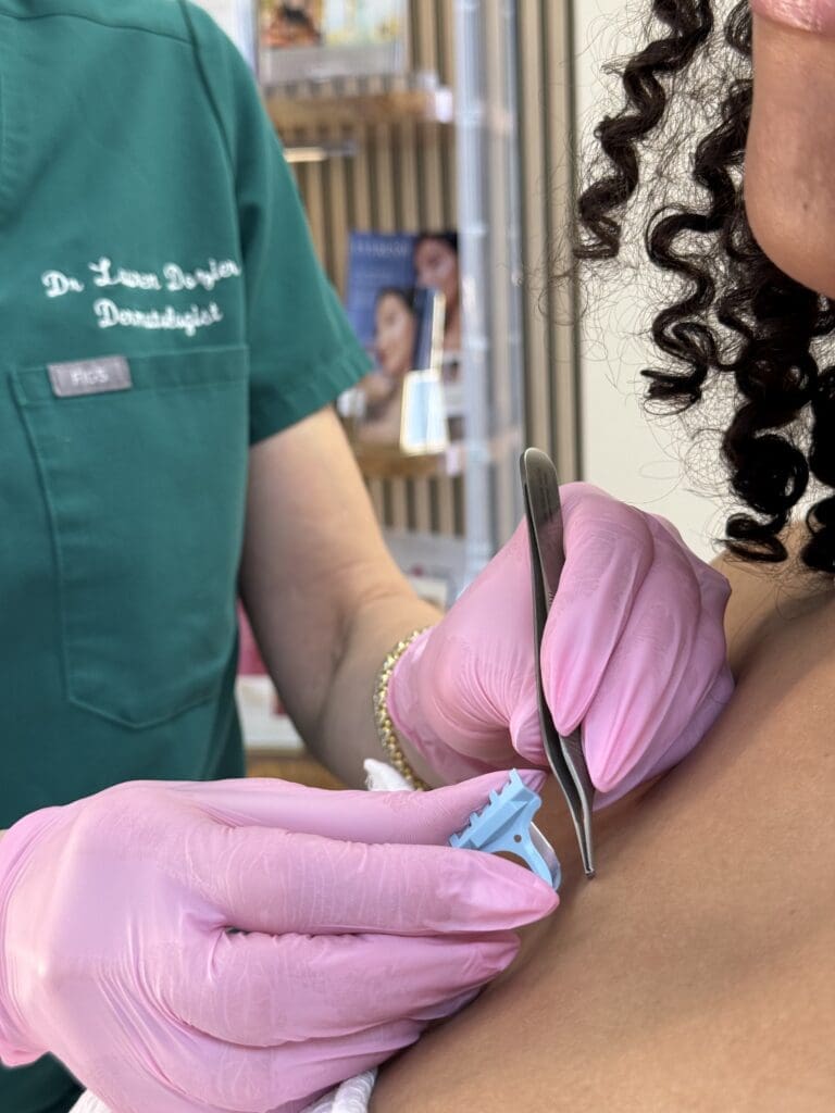 Dermatology 4 An image with the filename of SHAVE BIOPSY