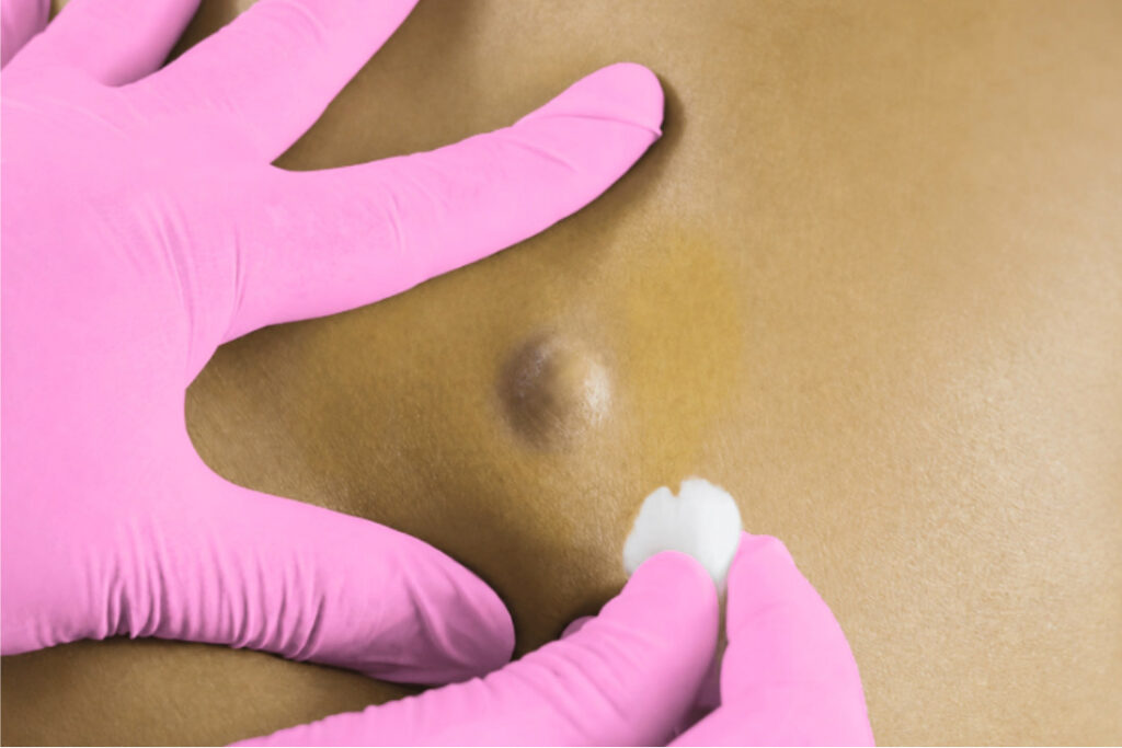 An image with the filename of LIPOMA CYST REMOVAL