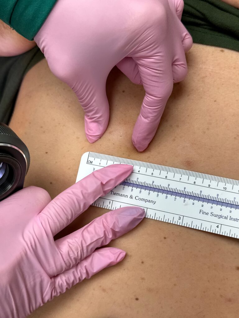 Dermatology 11 An image with the filename of LIPOMAS CYST REMOVAL